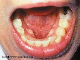 Mouth cancers usually begin as a flat lesion in any part of the oral cavity a white or red patch in the mouth an ulcer which does not heal on the lips or inside the mouth Mouth Cancer Oral Cancer Help