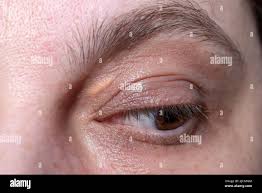 Image result for xanthelasma of eyelid