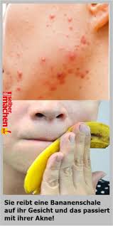Sie Reibt Eine Bananenschale Auf Ihr Gesicht Und Das Passiert Mit Ihrer Akne Bananenschale Bananen Schale Akne
