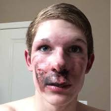 Right now, there is little regulation when then you can continue to cut back on a schedule until you no longer smoke or vape. E Cig Vape Explodes On Kids Face Imgur