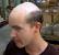 Buzz Cut Hair Thinning