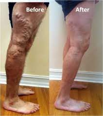 You may be surprised to find that your insurance covers many varicose vein treatment procedures when deemed medically necessary. additionally, most vein clinics will offer you a variety of payment methods for those treatments that insurance doesn't cover. Does Insurance Cover Varicose Vein Treatment East Bay Vein Specialists