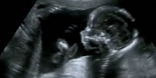 Does nuchal translucency go away? The New Prospective Parenthood When Does More Info Become Too Much Leaps Org