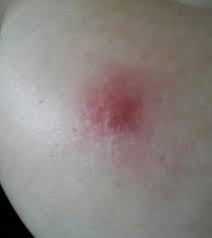 Was Genau Konnte Das Sein Und Wie Kriege Ich Es Weg Pickel Brust