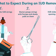 How to naturally eliminate the side effects of the mirena iud, such as bleeding & weight gain, and overcome the mirena as you now know, numerous side effects have been linked to the mirena iud implant. What To Expect During Your Iud Removal