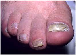 Image result for Onychotillomania feet