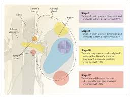 It is one of the ten most common cancers in both men and women. Renal Cell Carcinoma Nejm