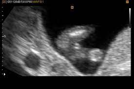Who Has Had Baby S Legs Crossed During Ultrasound Did You Have A Boy Girl The Bump