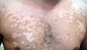 Câmp bright diametru cm nu cauza disconfort fizic și poate dura mai mulți ani. Cancer De Piele Pete Albe Cancer De Piele Pete Albe