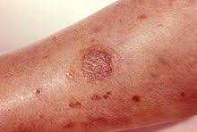 You will likely know right away if you have been bitten by a poisonous spider like a brown recluse if you have a spider bite and don't treat it fast, it may trigger a fever or chills. Spider Bite Wikipedia