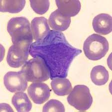 Leucémies aiguës et syndromes myélodysplasiques chapitre 3 : 220 Idees De Cytologie En 2021 Hematologie Telecharger Livre Pdf Les Infiltres
