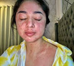 Muka seram is on facebook. Seram Ini Penampakan Wajah Dewi Perssik Yang Rusak Usai Positif Covid 19 Warta Pontianak