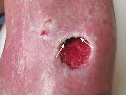 The eschar acts as a natural barrier to infection by keeping the bacteria from entering the wound. Wound Debridement Plastic Surgery Key