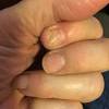 How long does it take for toenails to grow back? 1