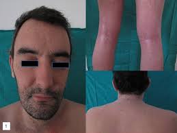 Image result for Atopic Patient