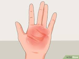 4 Manières De Soigner Une Brulure À La Main - Wikihow