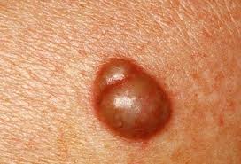 Image result for sore skin in the groin area
