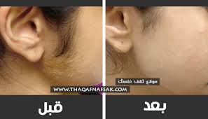إزالة شعر الوجه بوصفات تجعله لا ينمو بارز وبكثره مرة أخرى ثقف نفسك
