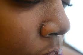 Home Remedies For Dry Nose Skin Dry Nose Skin Rid Dry Skin Dry Skin On Face