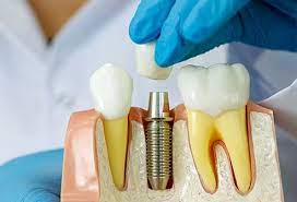 What type of dentist does implants. Dental Implants Procedure Cost Types Problems Safe