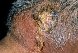Ready to knock those ingrown hairs out for good? Folliculitis And Skin Abscesses Skin Disorders Merck Manuals Consumer Version