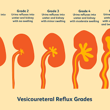 Vesicoureteral Reflux Symptoms Causes And Treatment
