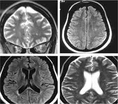 The internet journal of radiology. Mri Brain Showing Demyelinating Lesions Download Scientific Diagram