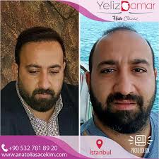 Gercek Dogal Sonuclar Ancak Gercek Tecrube Ve Uzmanlik Ile Mumkundur 0532 781 8920 Anatoliasacekim Com Anatoliahair Anatolias Sac Erkek Modasi Gercekler