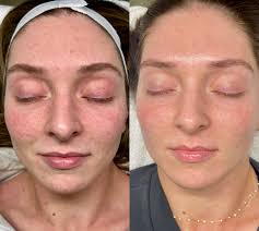 6 week series -BioRePeel 🧪