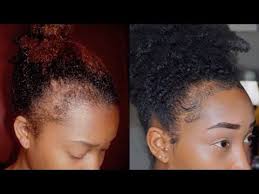 Get Those Edges Back How I Grew Out My Edges And Bald Spots Youtube Growing Out Hair Natural Hair Styles Natural Hair Updo