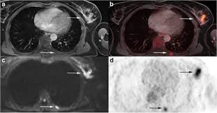 Detection of cancer prior to onset of symptoms (via several tests/imaging). Prospective Evaluation Of Whole Body Mri And 18 F Fdg Pet Mri In N And M Staging Of Primary Breast Cancer Patients Springerlink