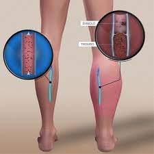 Symptoms include pain and swelling in one leg, chest pain, or numbness on one side of the body. Trombosis Ilustracion Trombo