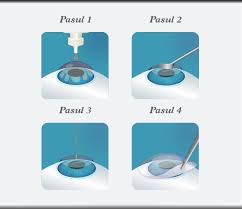 Suntem oftum, o clinica de oftalmologie specializata in operatiile cu laser. Prk Si Lasek Metode De Corectare A Dioptriilor Cu Ajutorul Laserului
