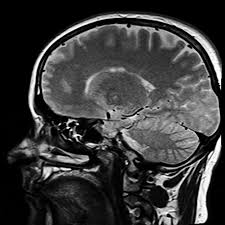 Kopf Magnetresonanztomographie Mrt Kostenloses Foto Auf Pixabay