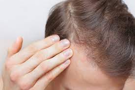 Hormonal hair loss treatment in Turkey | Clinics &Prices