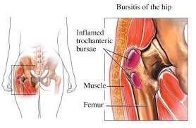 Image result for Bursitis