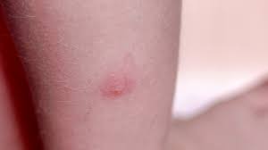 Maybe you would like to learn more about one of these? Mite Bites How To Know If You Have Them