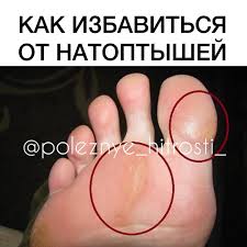 боль в пятке при ходьбе как лечить в домашних условиях Kak Izbavitsya Ot Natoptyshej Malenkaya Prosba Kto Zaberyot K Sebe Recept V Zakladki Ostavte Lyuboj Sm S Izobrazheniyami Tovary Dlya Zdorovya Domashnie Sredstva Naturopatiya