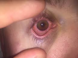 Image result for Hyphema