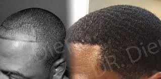 This is a scarring condition that results in hair loss. What To Know About African American Hair Transplants Hair Transplant