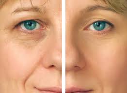 Ojeras Oscuras Eliminalas Ivance