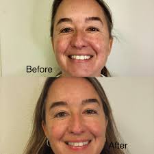 😍This is the power of RF microneedling!! Less than 1 week after her very  first treatment and you can see how much the sun spots have faded, how  smooth the skin looks