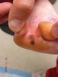 Many people assume that a mole on a toe is more likely to become melanoma, or, already is this deadly skin cancer. What You Should Know About Malignant Melanoma Podiatry Today Hmp Global