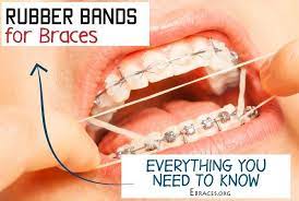 Metal rings metal rings are made to fit at the back of the teeth. Everything You Need To Know About Rubber Bands For Braces