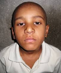 Primary alveolar rhabdomyosarcoma: a horrendous presentation with  miraculous remission