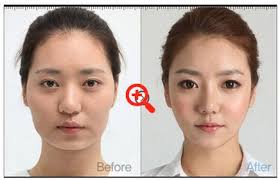 31 Crazy Before And After Photos Of Korean Plastic Surgery Korean Plastic Surgery South Korean Plastic Surgery Plastic Surgery Pictures