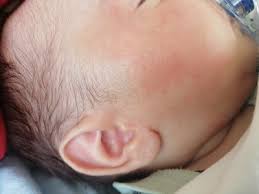 bebegimin yanaklari kizardi