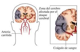 Symptoms may include headache, abnormal vision. Que Es Una Trombosis Cerebral Trombosis Del Seno Venoso Clever