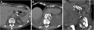 Early postoperative imaging after non-bariatric gastric resection: a primer  for radiologists