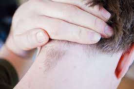 They're hairs that have grown into your skin. What Does An Ingrown Hair On Your Head Look Like